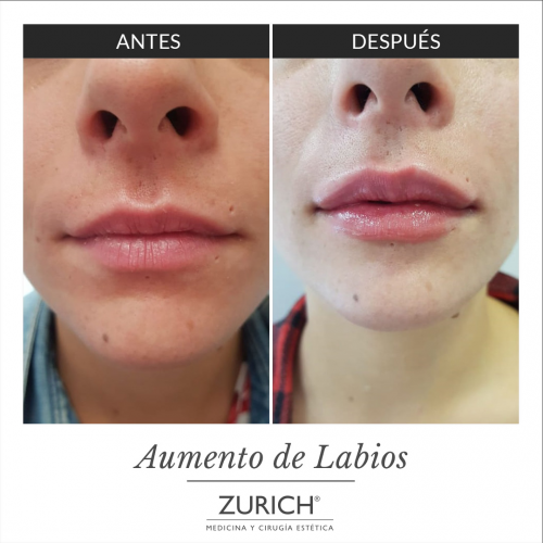 Antes y despu�s � Aumento de labios